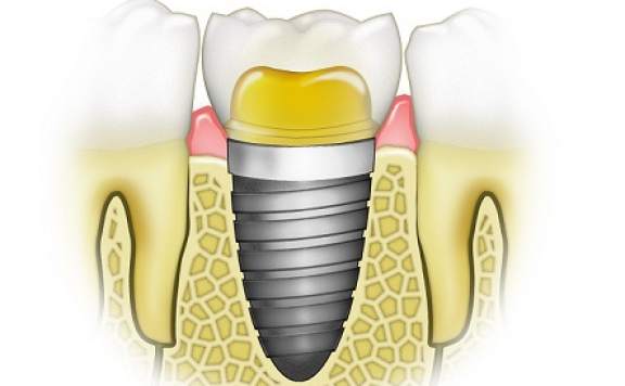 İMPLANT İLE İLGİLİ MERAK EDİLEN 6 SORU
